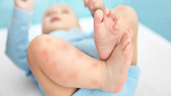 Beberapa Jenis Alergi Kulit pada Anak yang Harus Bunda Ketahui